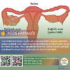 Pcos Hastalığı
